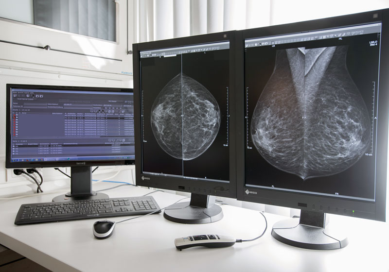 Mammographie-03_800x560.jpg
